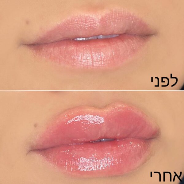 עיבוי שפתיים - לפני ואחרי